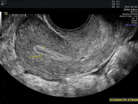 how to measure endometrial thickness on ultrasound|17mm endometrial thickness postmenopausal.